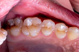 how to prevent cavities naturally